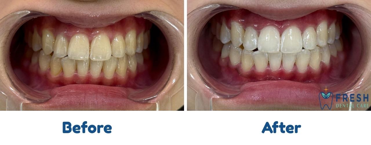 teeth whitening