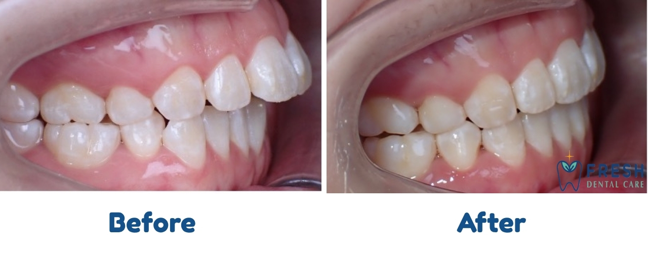 braces