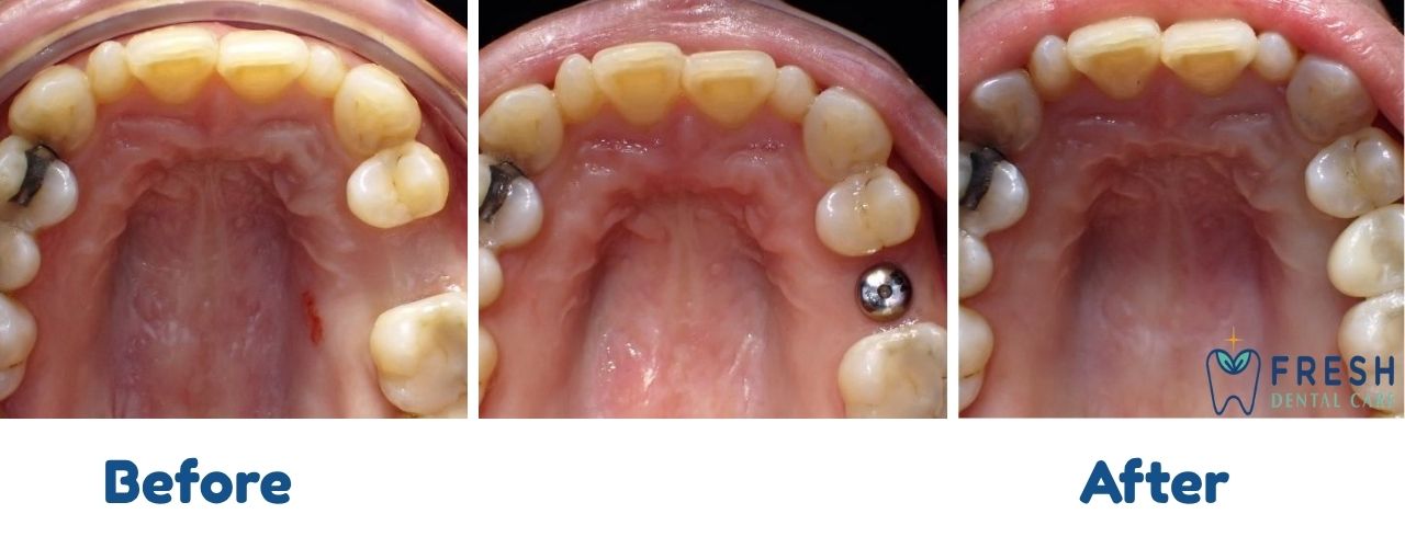dental implant