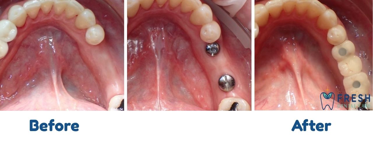 dental implant