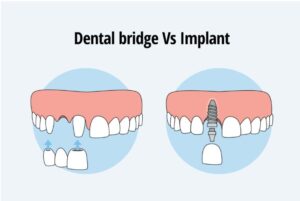 dental bridge vs implant