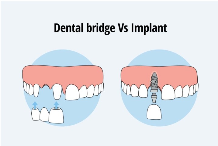dental bridge vs implant