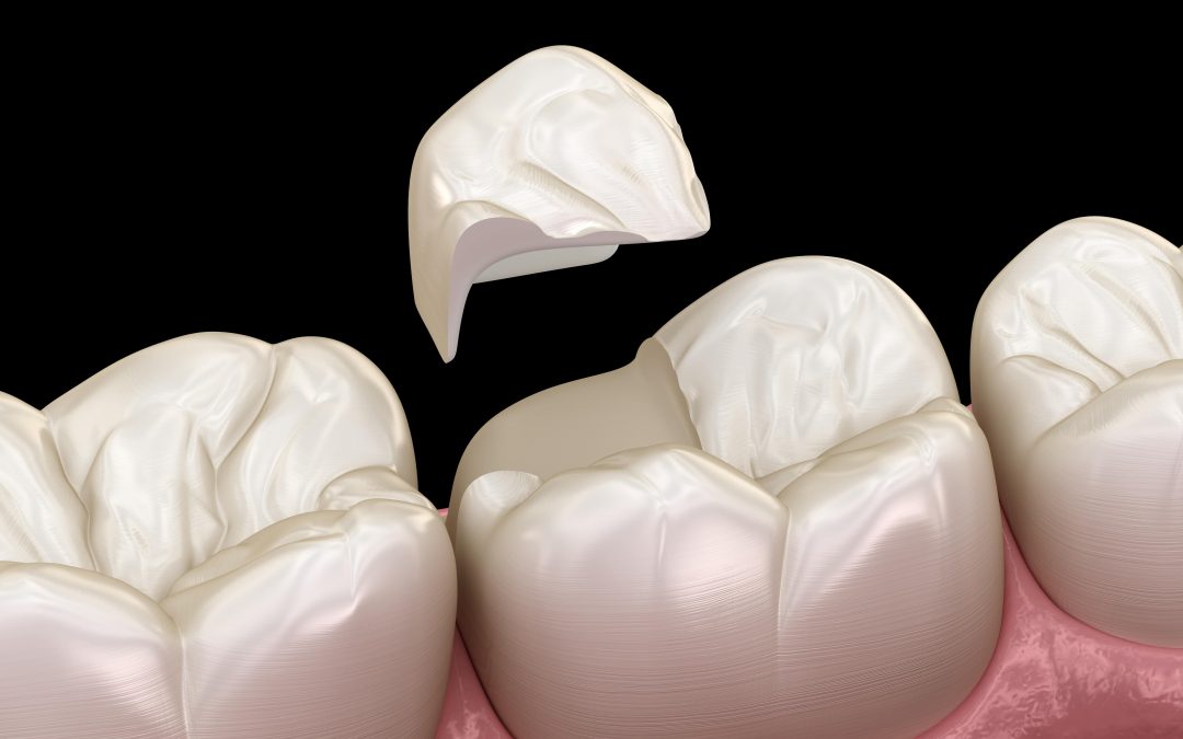 dental crowns