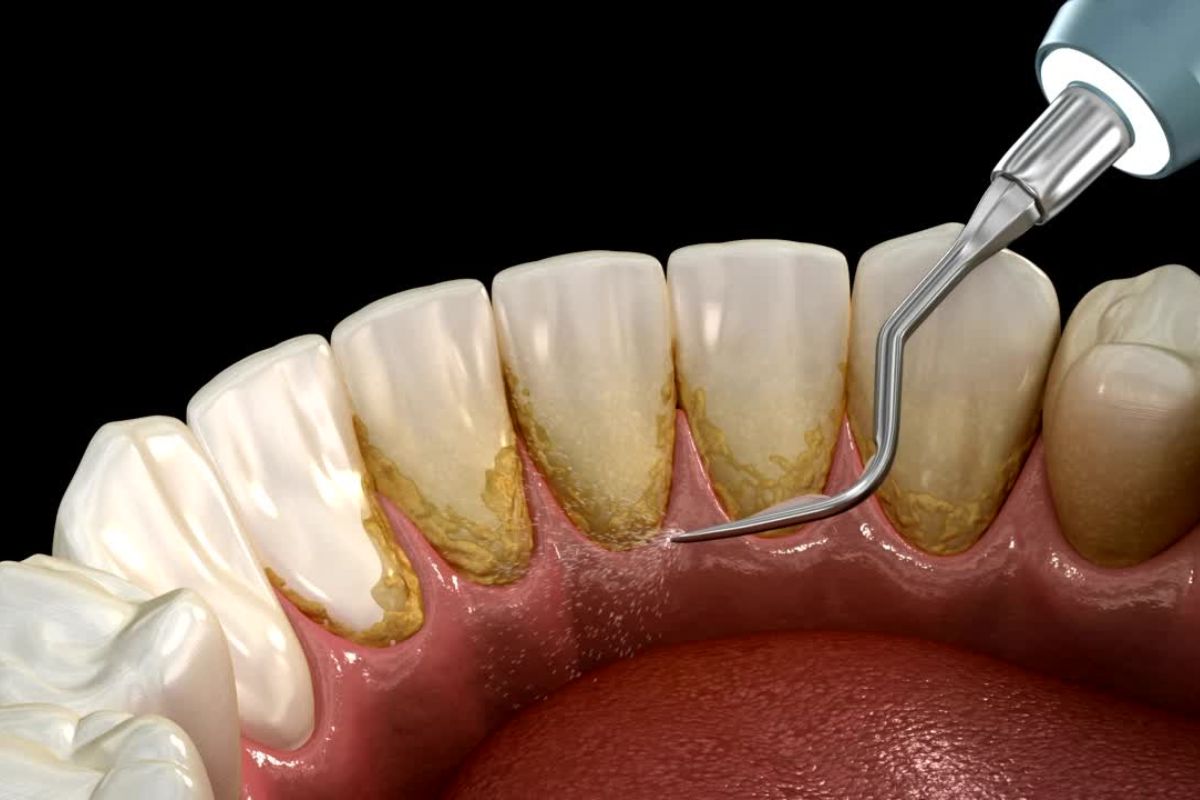 teeth tartar