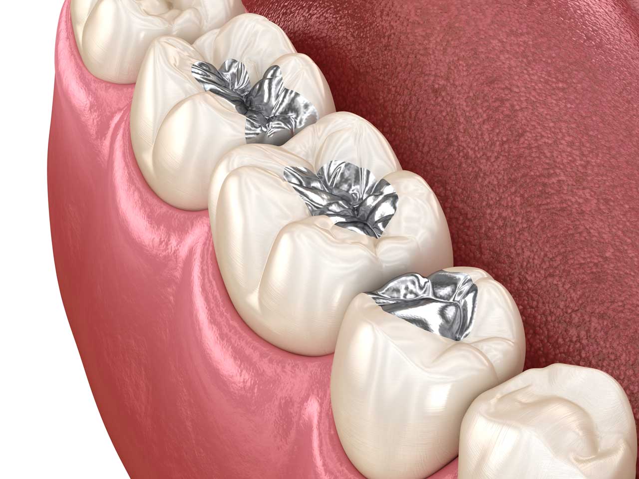 amalgam filling