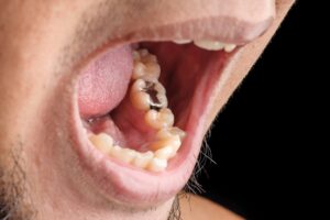 Composite vs Amalgam Fillings: Which Is Better? 3 amalgam filling vs composite fillings