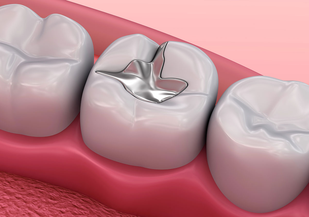 composite fillings