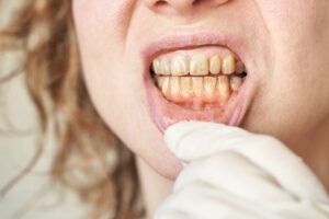 Yellow Teeth, Tartar & Plaque: What They Mean and How to Treat Them 4 yellow teeth and plague