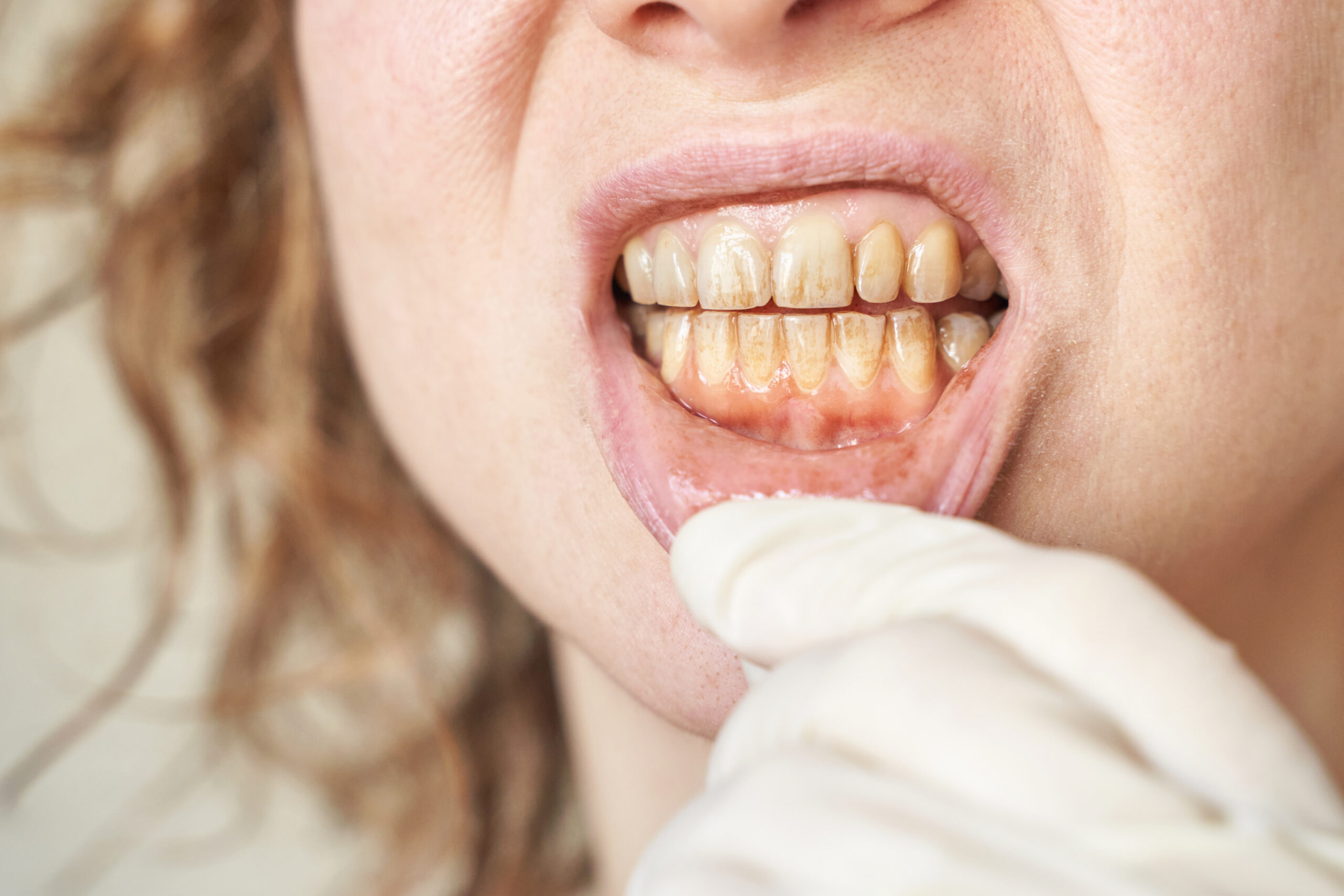 yellow teeth and plague