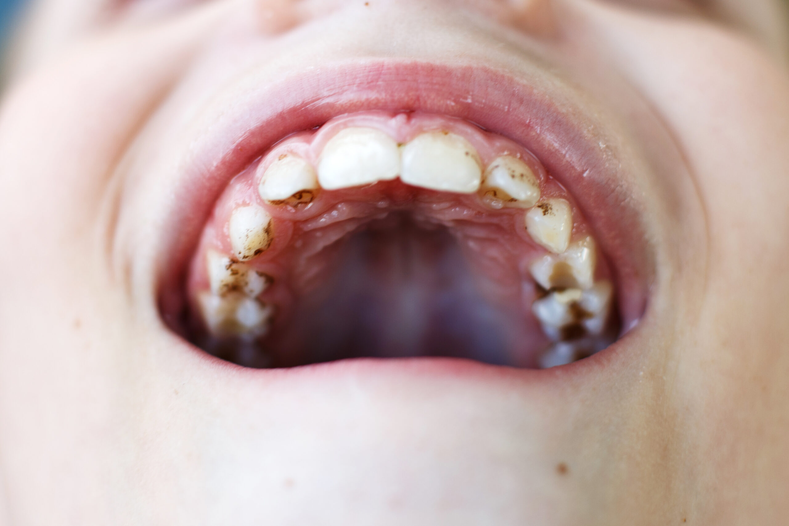 teeth plague