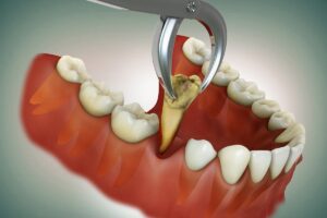 tooth extraction
