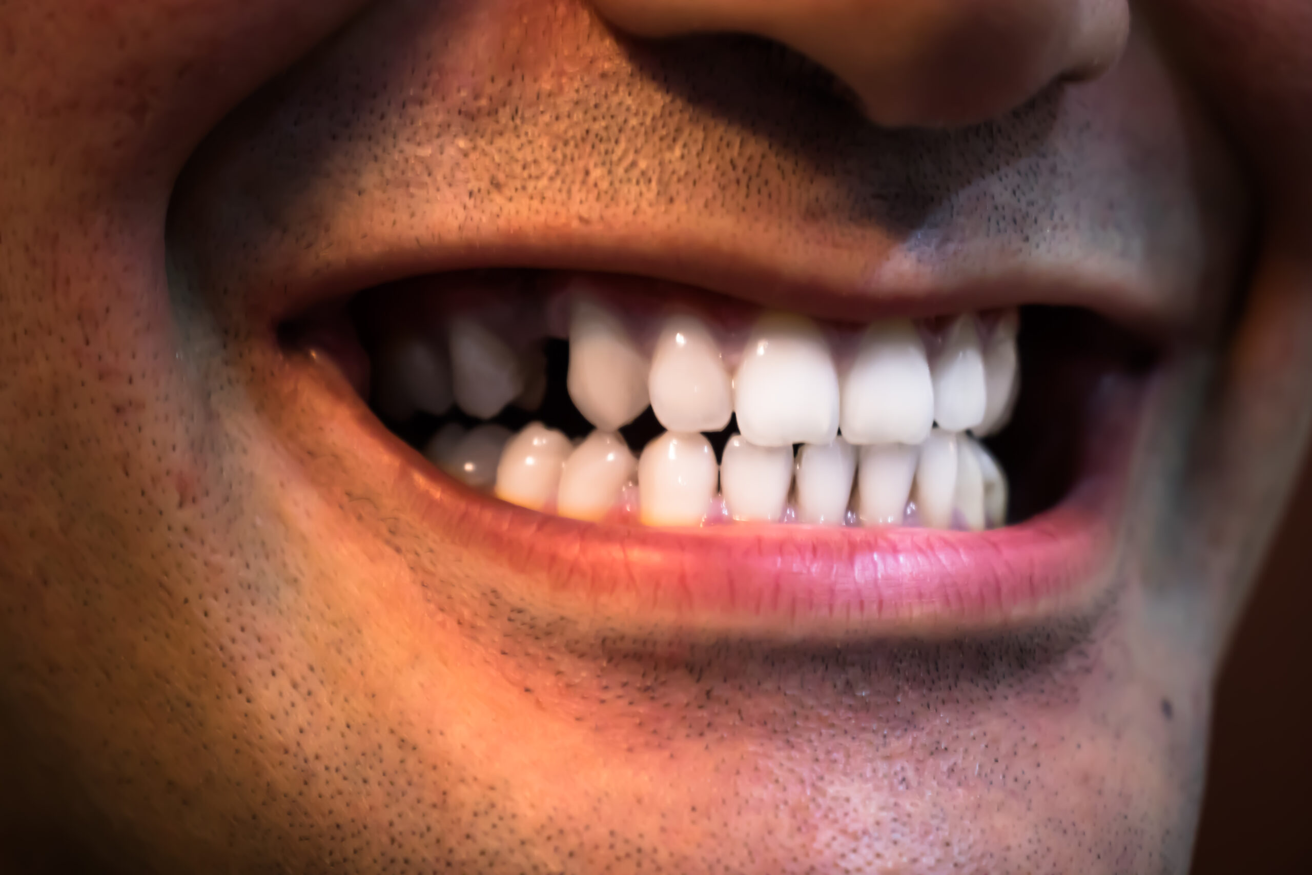 teeth gap
