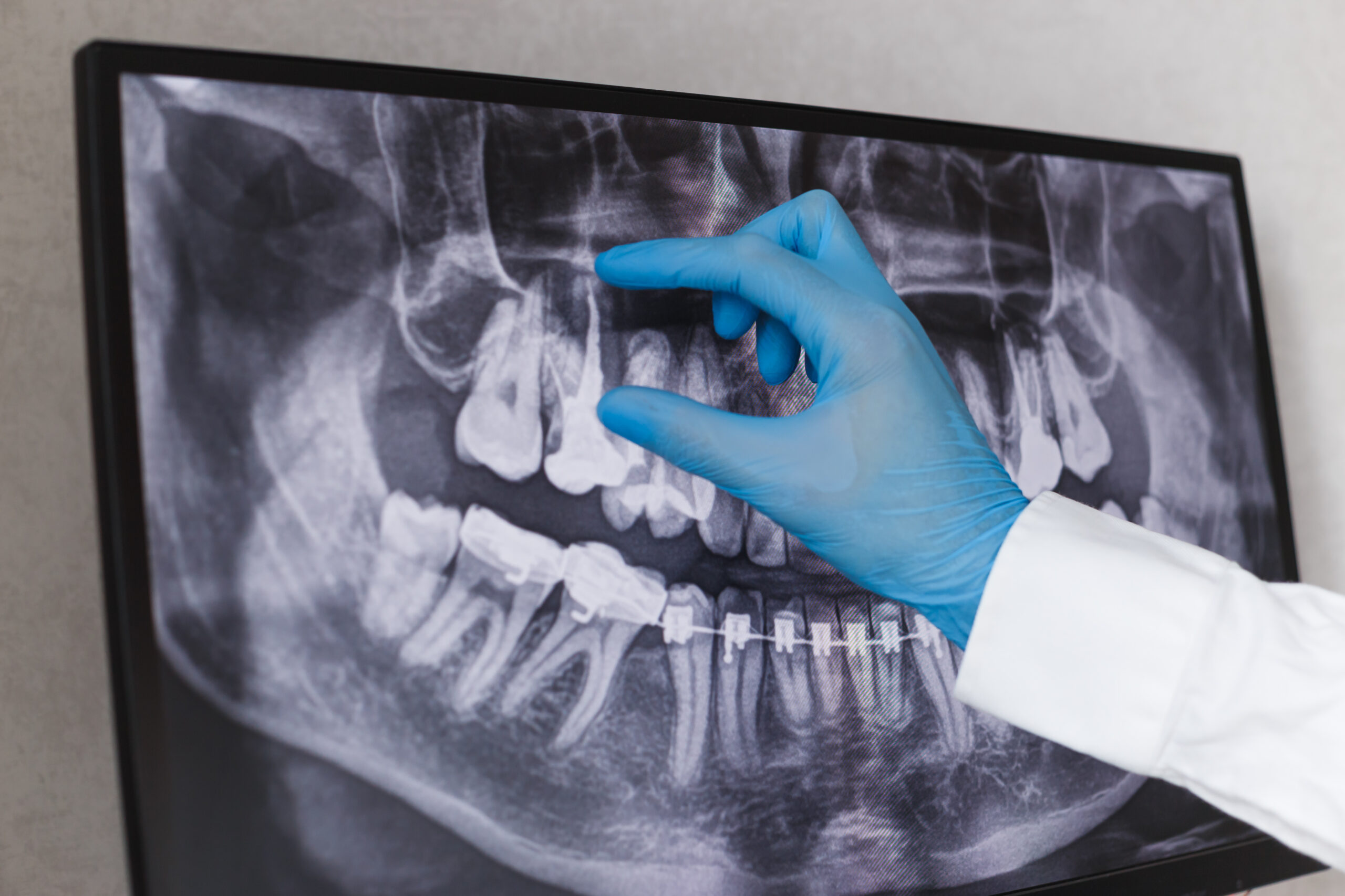 tooth extraction X-ray