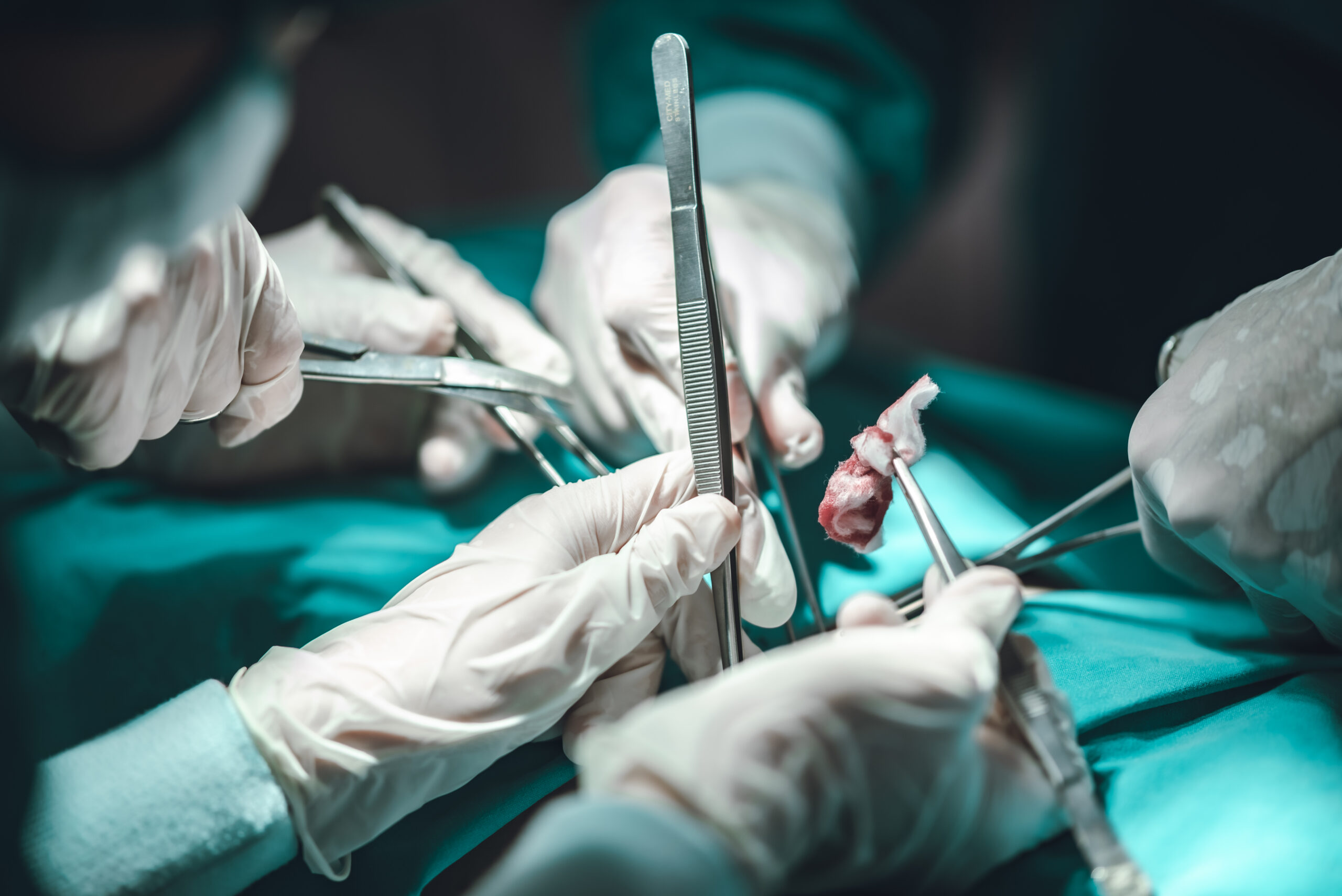 wisdom tooth extraction