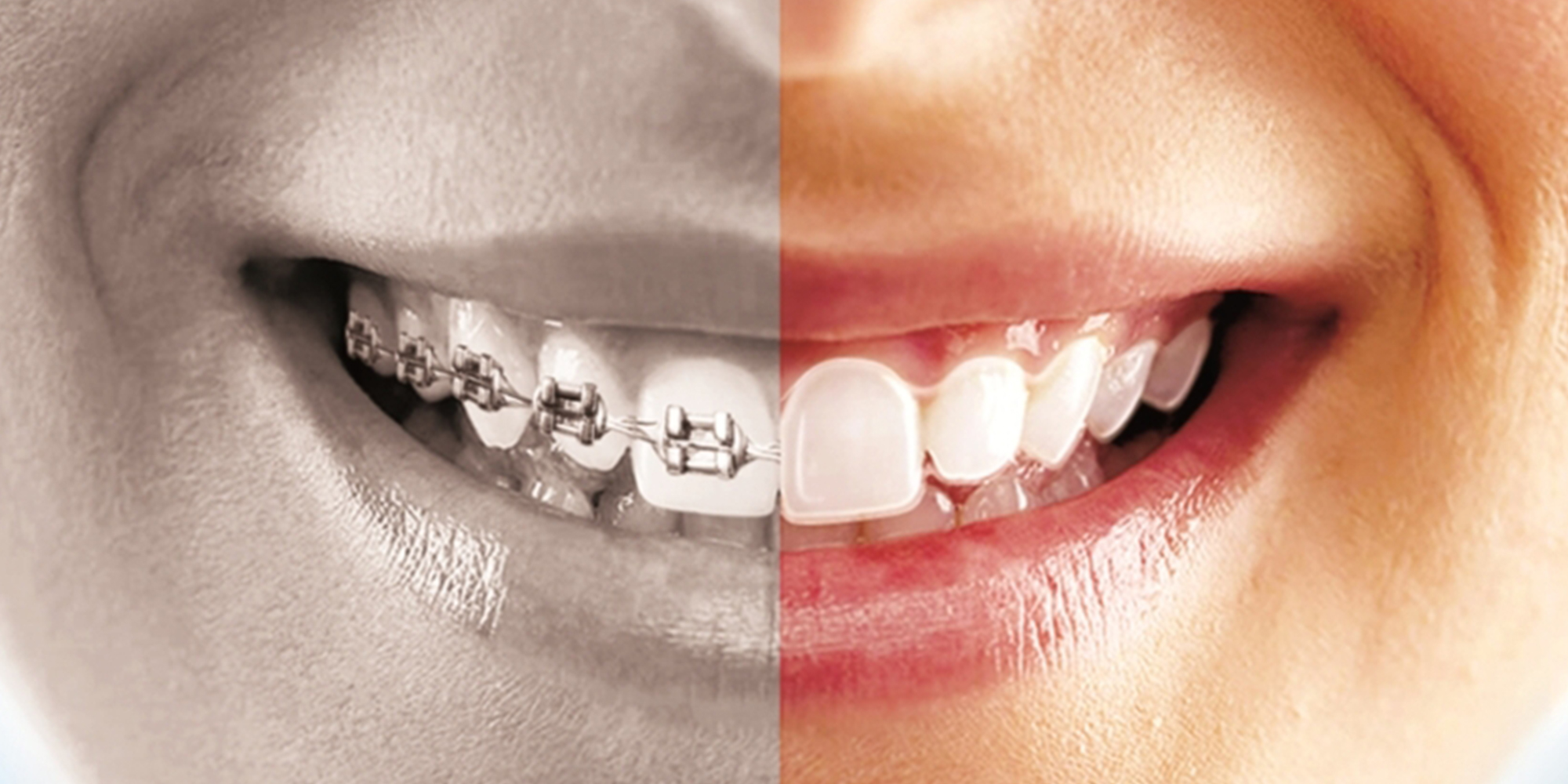 aligners vs braces