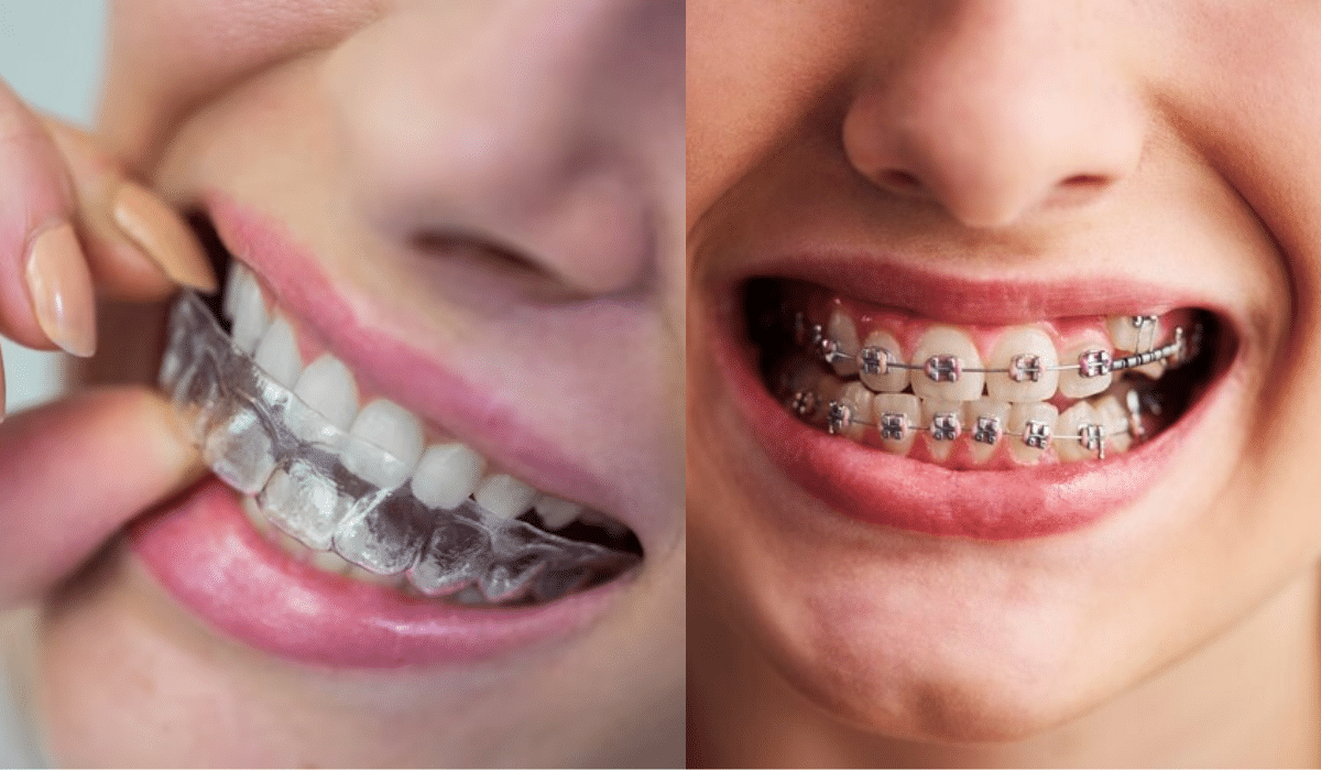 aligners vs braces