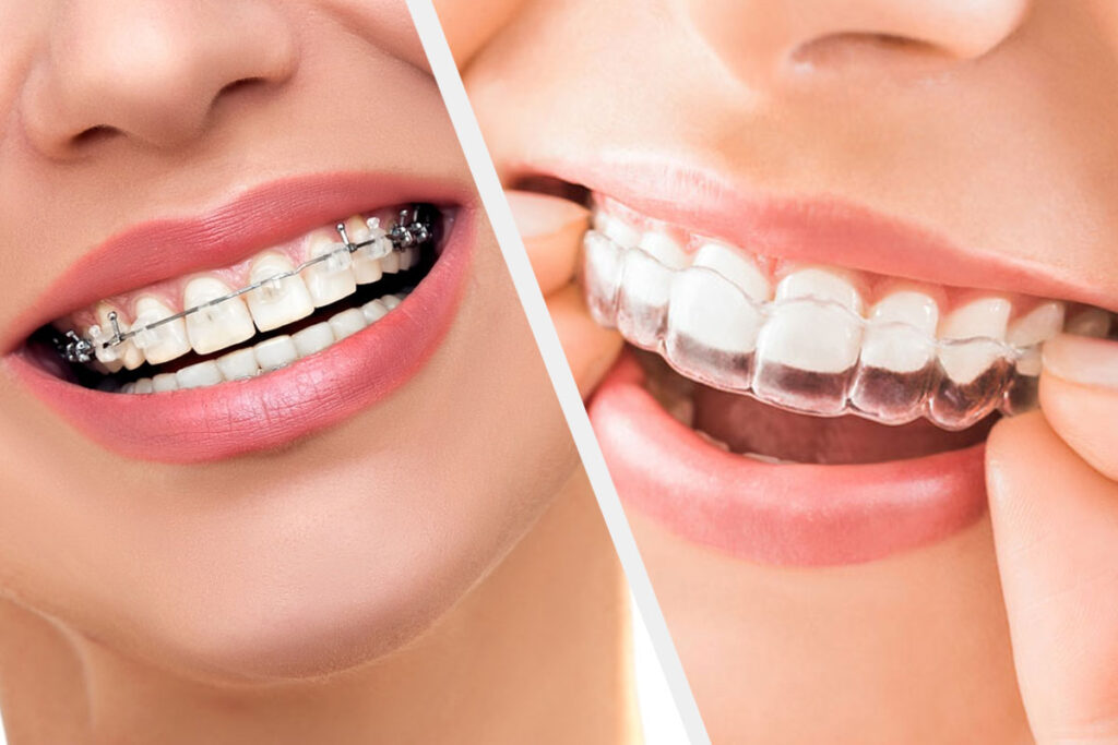 aligners vs braces