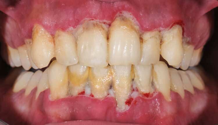 poor oral hygiene