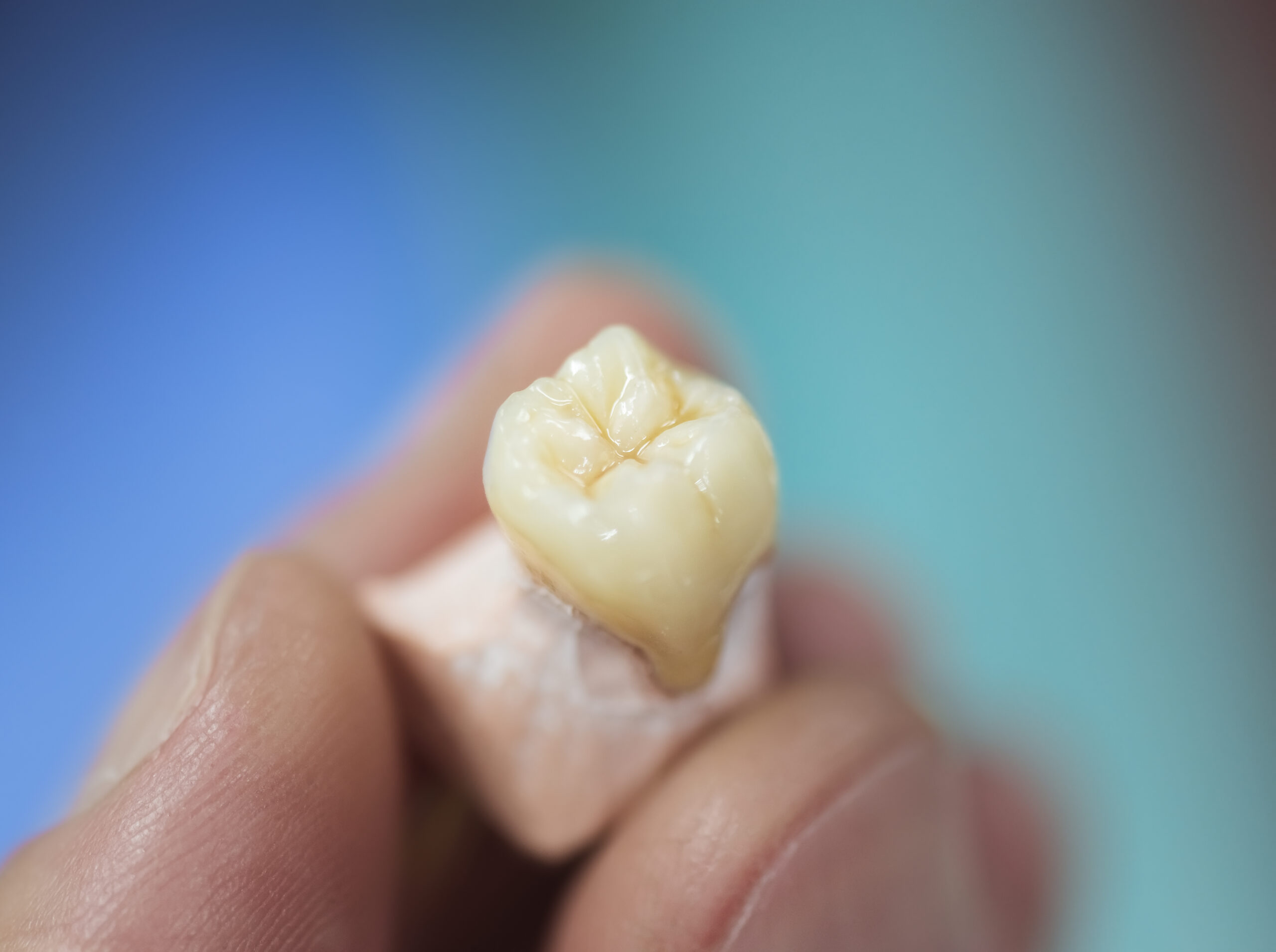 When Does a Damaged Tooth Need a Dental Crown Instead of a Filling? 2 dental crown