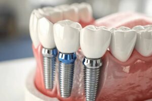 dental implants