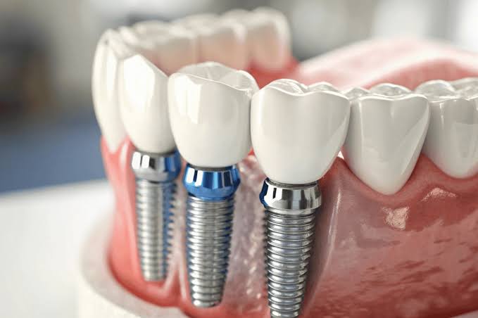 dental implants