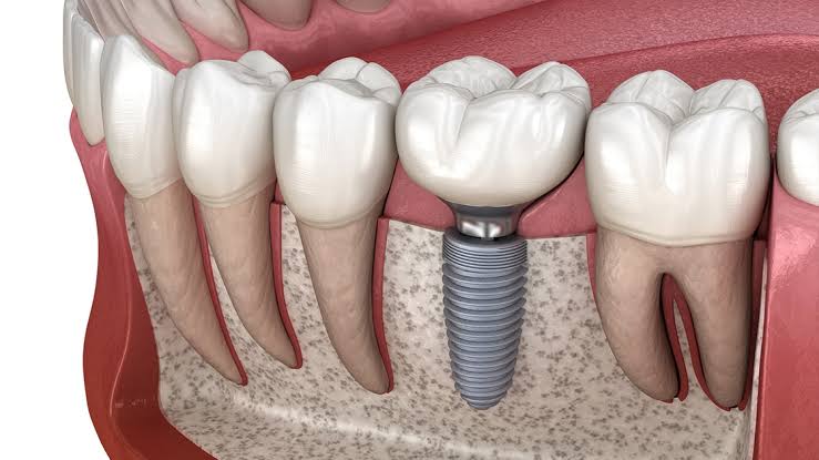 how to make dental implant last longer