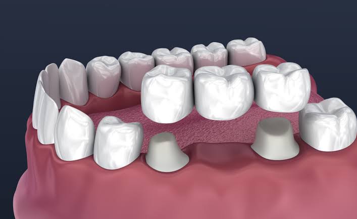 When Does a Damaged Tooth Need a Dental Crown Instead of a Filling? 3 crown bridge teeth