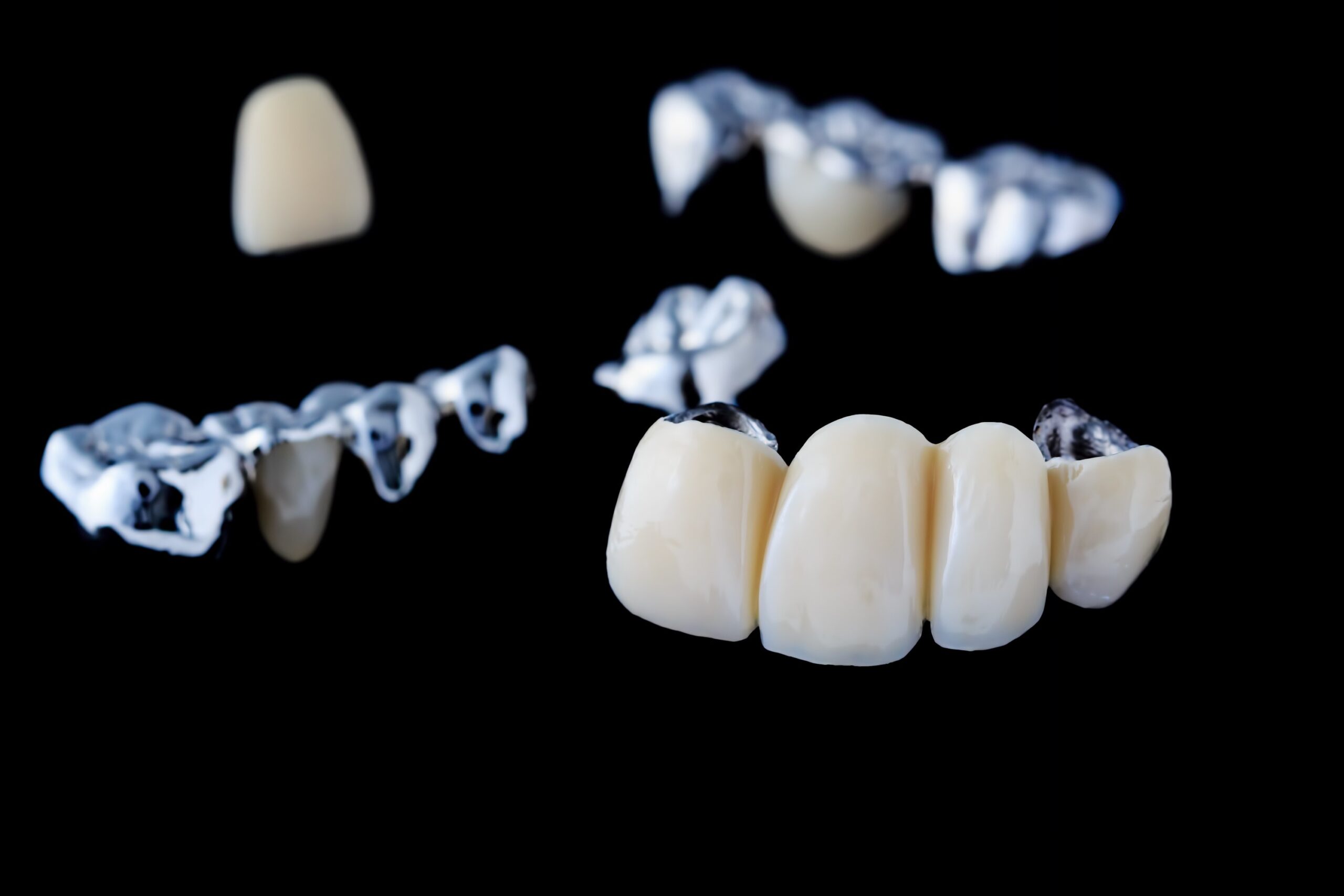types of dental bridges